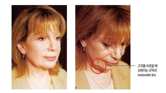(보도기사) 얼굴 주름 성형, 정확한 수술방법으로 확실한 주름 개선 효과를 얻자!