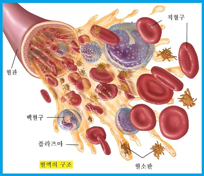 급성 백혈병(Acute Leukemia)의 증상 및 원인, 치료방법
