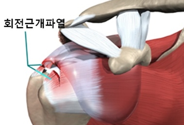 회전근개파열 증상이 의심되는 어깨통증