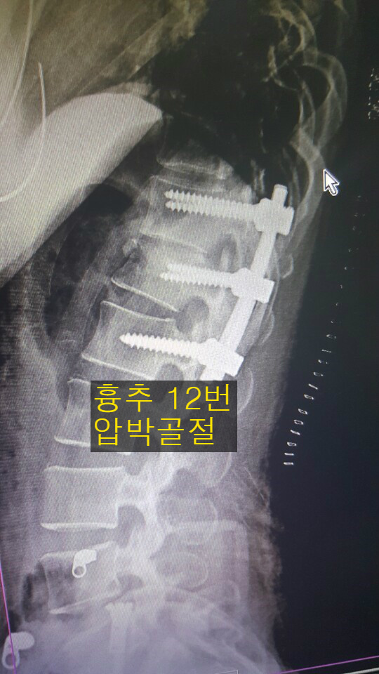 흉추11번,12번 압박골절과 고정술 기형장해 예상!!