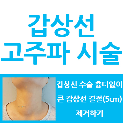 갑상선 고주파 시술, 5cm  짱이네