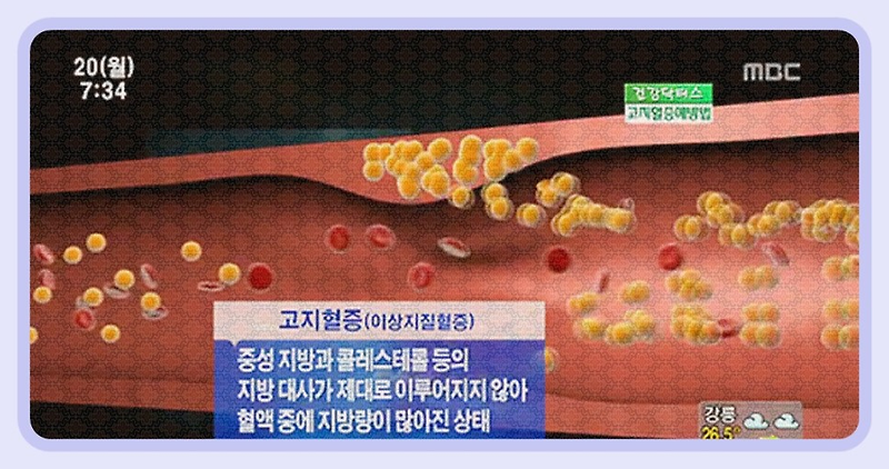 고지혈증약 부작용과 치료 대박