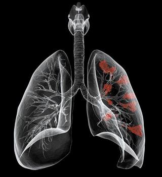 폐암 초기증상, 3기, 4기 생존율과 치료에 대해서