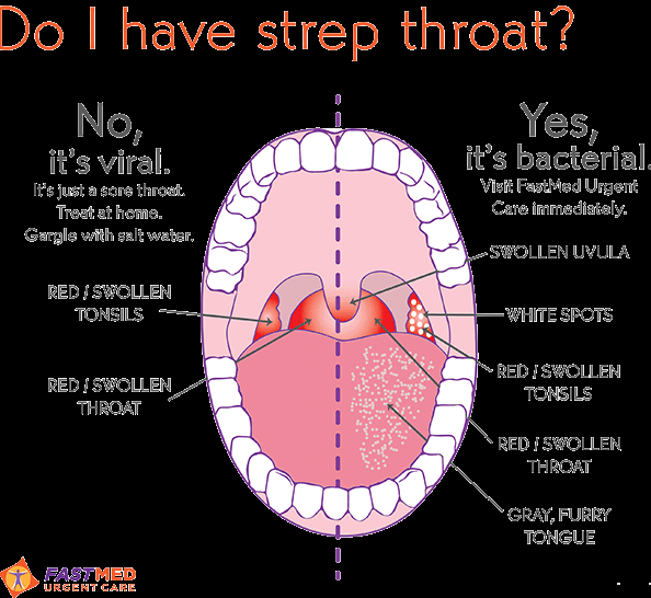 편도염, Strep throat과 virual tonsillitis 구분