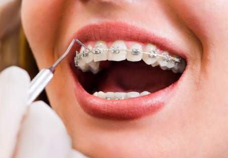 치아교정 비용 평균은?