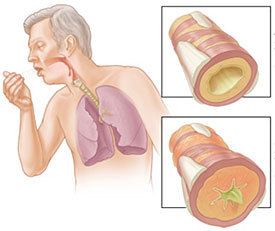 만성폐쇄성 폐질환 COPD 증과 원인, 치료