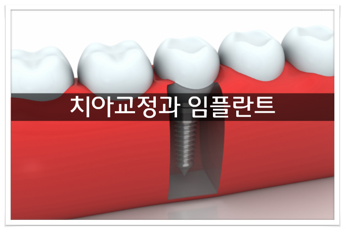 치아교정과 임플란트