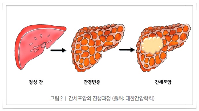 간이안좋을때,간암증상, 간에좋은음식