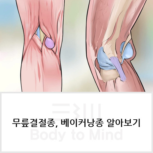 무릎결절종(knee ganglion), 베이커낭종(Baker's cyst) 알아보기