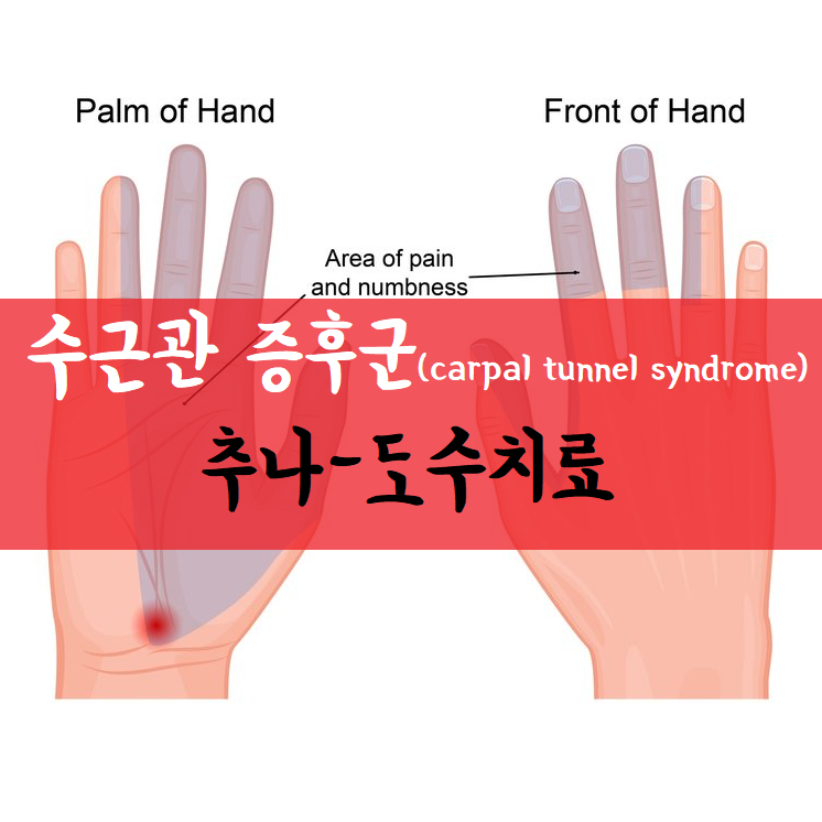 수근관 증후군, 손목 터널 증후군, 추자신- 확인
