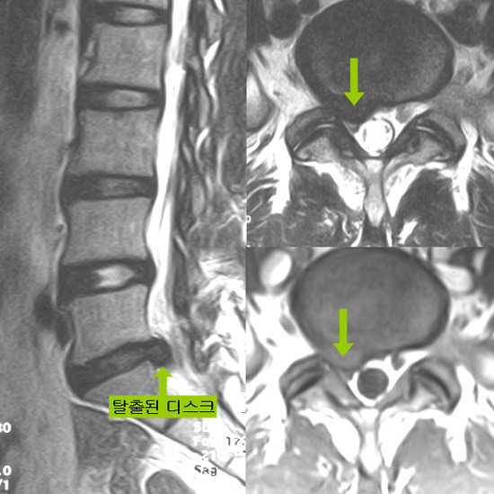 헉. 컴터 오래햇더만 추간판탈출증 걸린거 아닌지