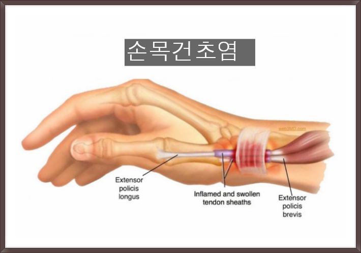 손목통증 손목건초염 치료방법