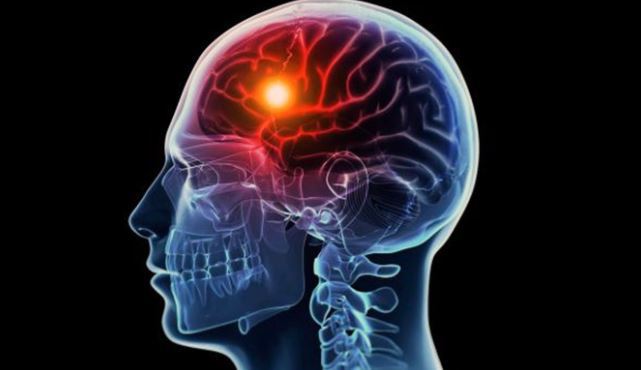 뇌졸증 증상 및 인지방법 관찰
