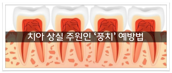 치아질환 충치,풍치 예방법