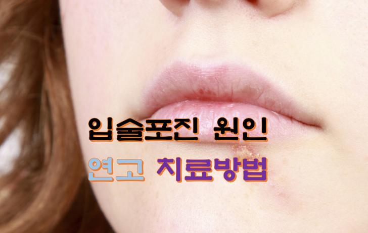입술포진 원인 연고 치료방법