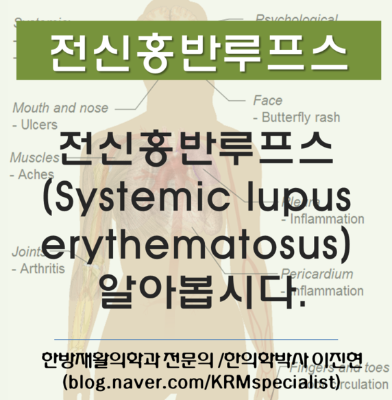 [전신홍반루프스/증상] 마이클잭슨이 앓았던 병! 전신홍반루프스(systemic lup 봅시다