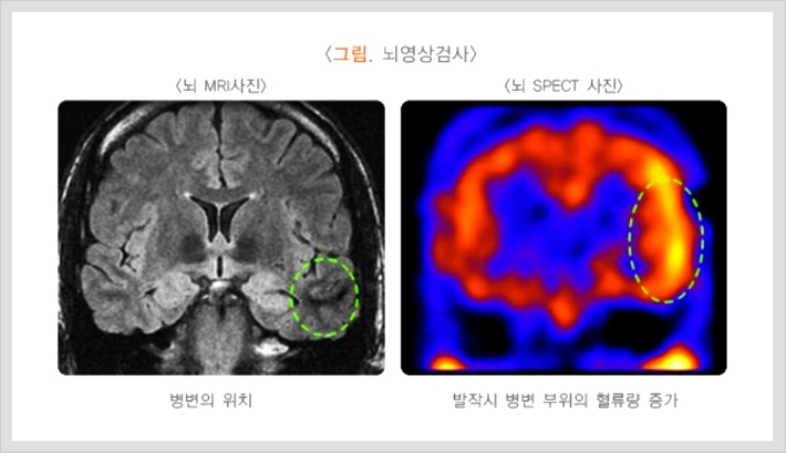 뇌전증 진단과 검사