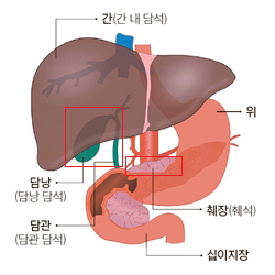 담석증, 췌장염인 사람을 위한 식사 및 생활지침