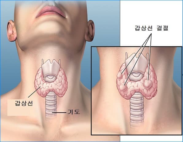 갑상선암(Thyroid Cancer)의 증상 및 원인, 치료방법