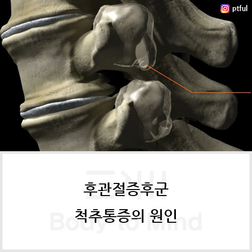 후관절증후군(facet joint syndrome), 척추통증(vertebra pain)의 원인