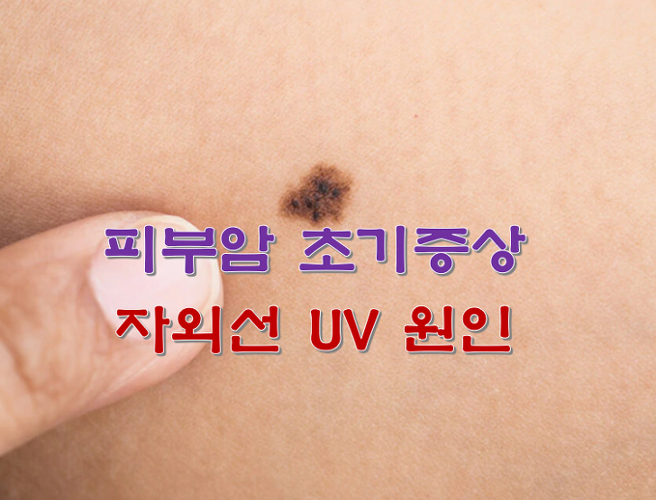 피부암 초기증상 자외선 UV 원인