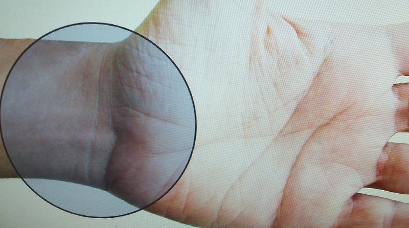 손목터널증후군 증상 및 손목아픔 예방