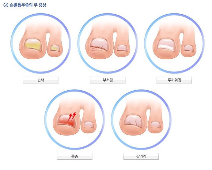 손톱 발톱 무좀과 약물 치 알아봐요