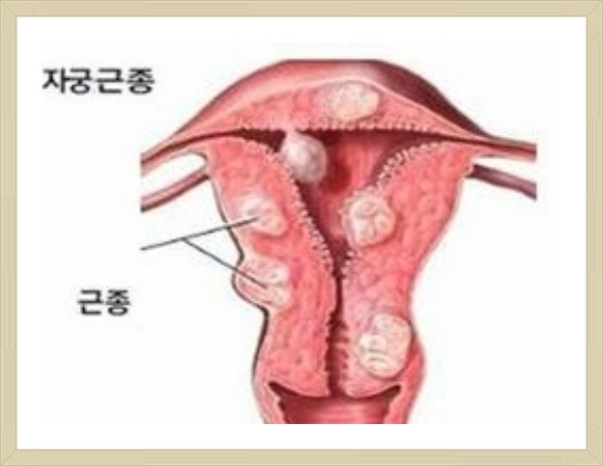 자궁선근증 치료 자궁적출술