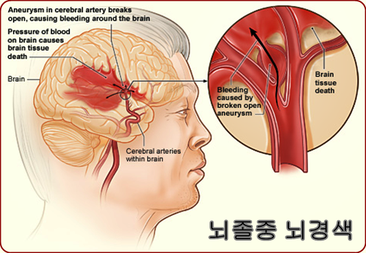 뇌졸중은 뇌경색, 뇌출혈로 갈리는 뇌질환