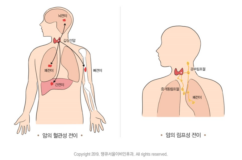 [갑상선암]갑상 ??