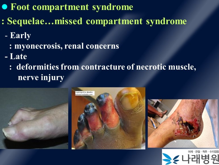 [과인래병원, 발] 구획 증후군의 무서움, Compartment syndrome of foot.