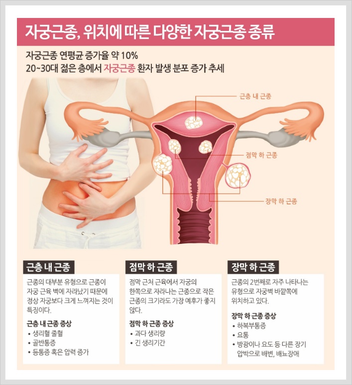 자궁근종  초기 증상