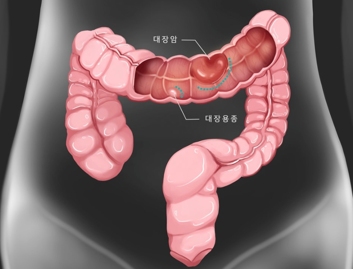 한국인이 잘 걸리는 암 2편 대장암 초기증상 및 예방법