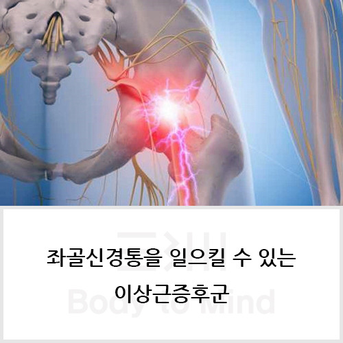 좌골신경통(sciatica)을 일으킬 수 있는 이상근증후군(piriformis syndrome)