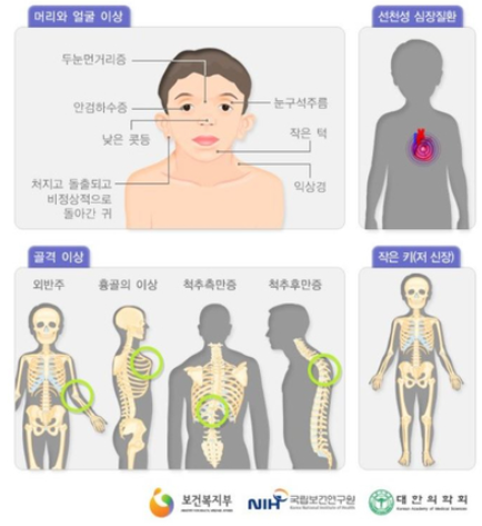 누난 증후군 총정리