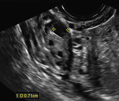 다낭성 난소 증후군 (Polycystic Ovarian Syndrome) - 원인, 증상, 진단