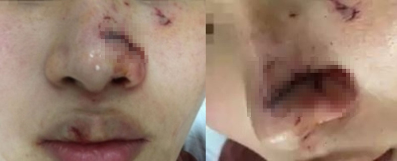 20대 여성 유명 사진작가 시바견에 얼굴 물려 13바늘 꿰매 견주 고소