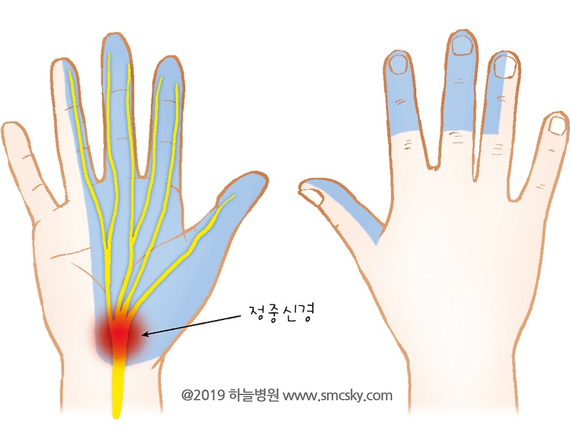 손목터널증후군 자가 진단 및 손목 통증을 위한 운동, 테이핑 방법