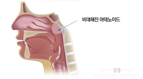 유아 편도아데노이드 수술, 편도수술 후 식단