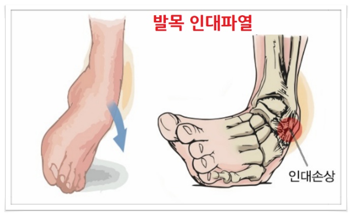 발목인대파열,발목 접질렀을때 응급처지방법