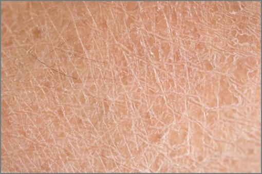 피부건조증의 원인과 예방 및 관리방법
