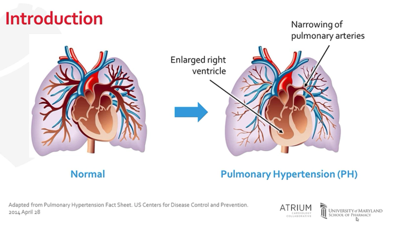 Pulmonary Hypert 대박