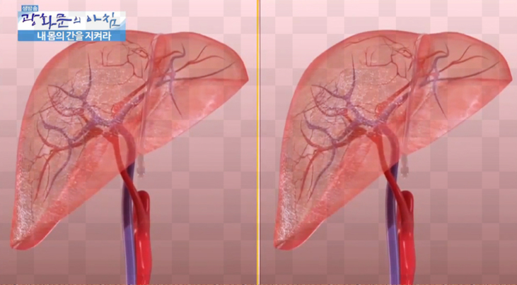 간 혈관종 총정리