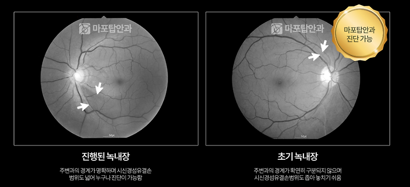 녹내장검사비결 녹내장연구회  !!