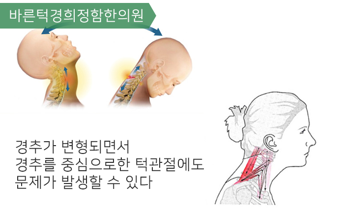 턱관절장어린이, 교통사건후 발생률높아진다