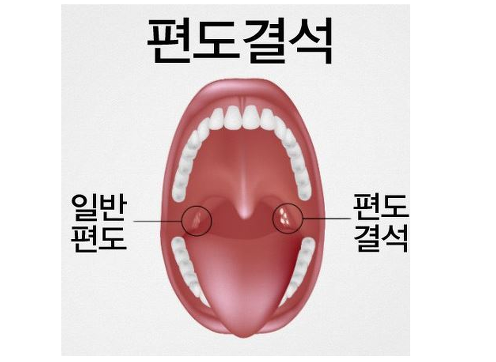 편도결석 수술 고주파 편도위축술 수술 리얼 후기!!!!(광고X)