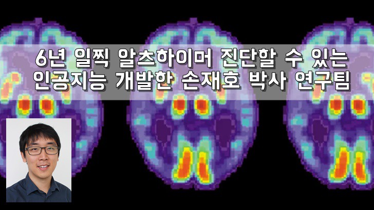 알츠하이머(치매) 조기진단하는 인공지능 개발한 손재호 박사연구팀