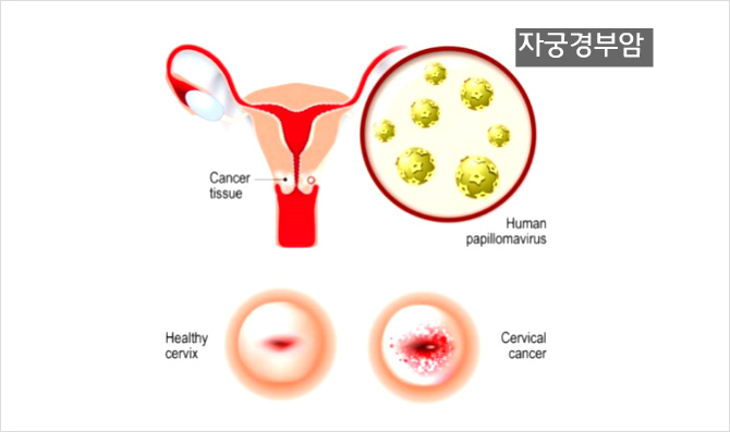 자궁경부암 원인