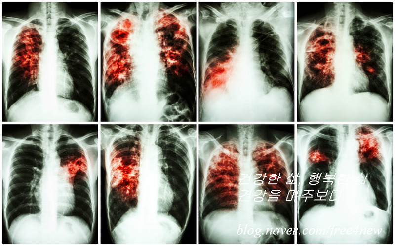 폐섬유증 폐가 굳는 원인 모를 질병