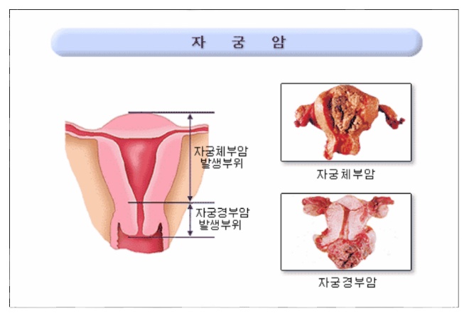 자궁암 초기증상